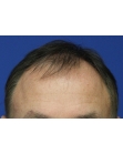Before Hair Transplant  Front